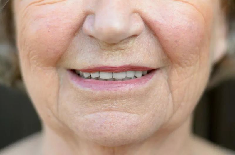 Tiêm rãnh cười - Giải pháp xóa nhăn hiệu quả và an toàn Việc thiếu hụt collagen cũng là nguyên nhân khiến rãnh cười xuất hiện