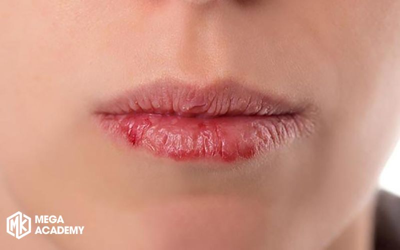 Có nên dặm lại môi lần 3 không? Xăm môi nhiều lần hại gì? Môi bị khô và nứt nẻ liên tục