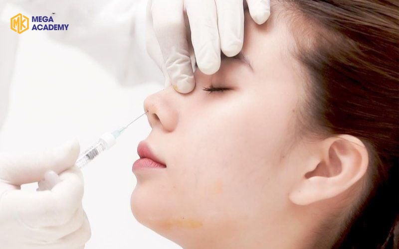 Tiêm filler bao lâu thì tan hết và các yếu tố ảnh hưởng Tiêm filler bao lâu thì tan sẽ không còn là vấn đề lớn nếu bạn biết chăm sóc các vùng da tiêm đúng cách