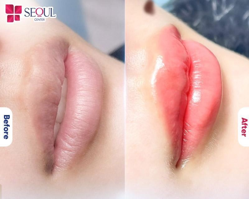 Hình ảnh môi khách hàng trước và sau khi phun môi collagen cực kỳ tươi tắn, quyến rũ, tự nhiên